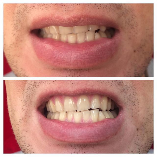 Косметическое отбеливание зубов отзывы white smile зубная щетка курапрокс 1560