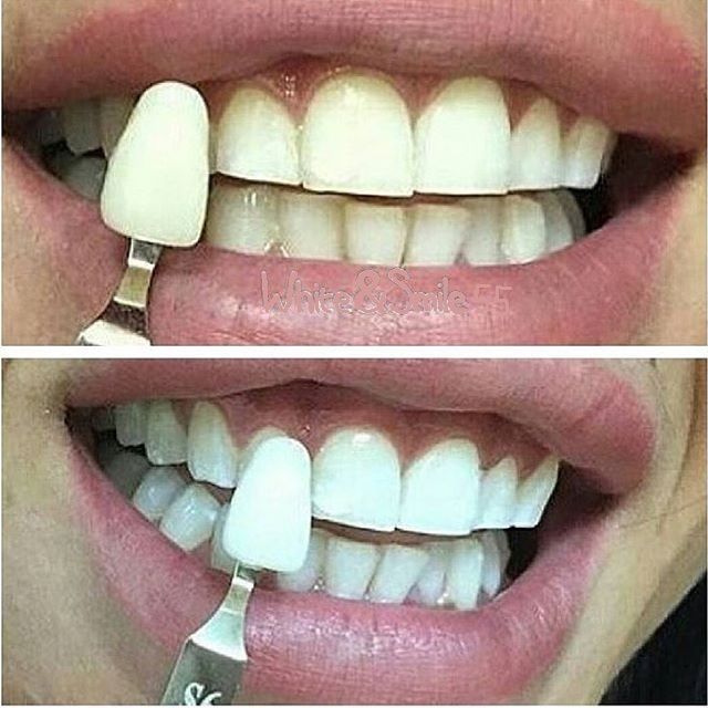 косметическое отбеливание зубов до и после фото