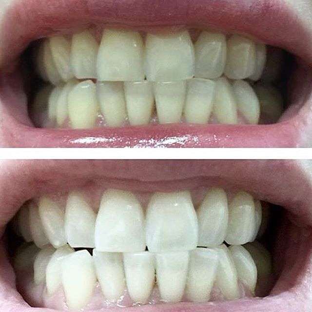 Фото 13171070 в коллекции Косметическое отбеливание зубов до и после - White&smile - отбеливание зубов