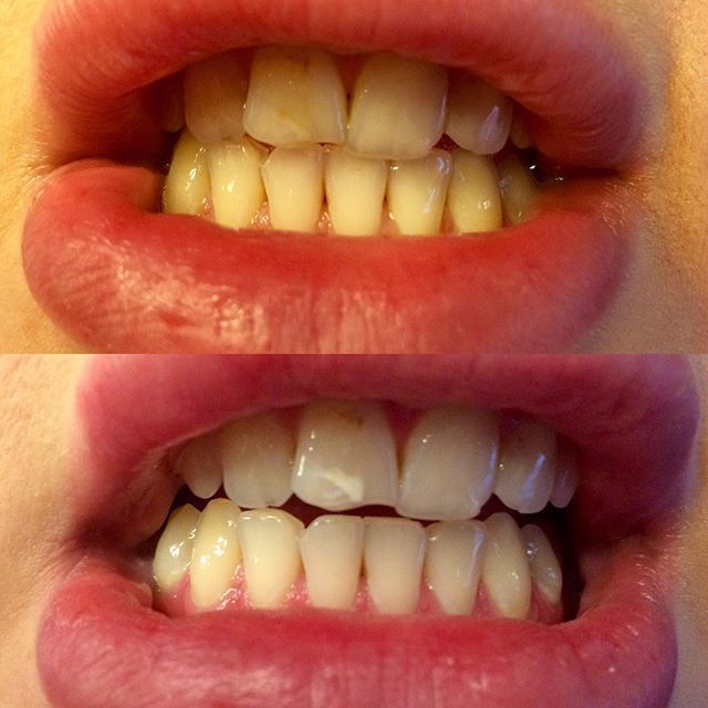 Фото 13171092 в коллекции Косметическое отбеливание зубов до и после - White&smile - отбеливание зубов