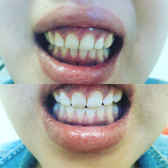 Фото 13171102 в коллекции Косметическое отбеливание зубов до и после - White&smile - отбеливание зубов