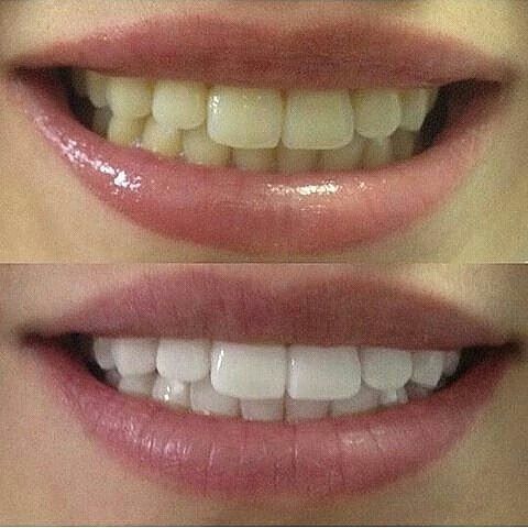 Фото 13330580 в коллекции Косметическое отбеливание зубов до и после - White&smile - отбеливание зубов